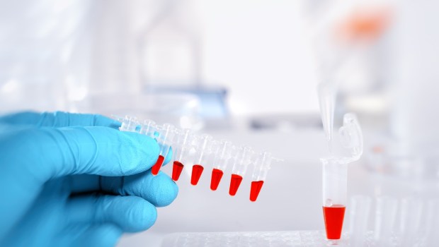 BIOMARQUEURS TRISOMIE 21